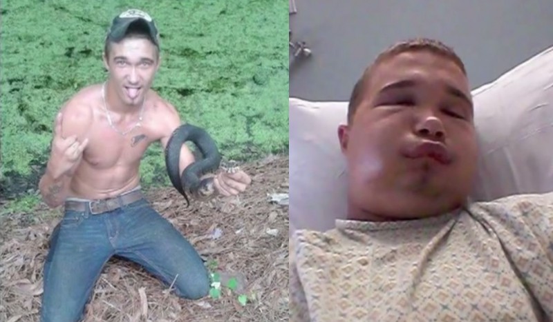 Austin Hatfield holding what appeared to be the cottonmouth before the incident (left) and and in the hospital after the bite (right).